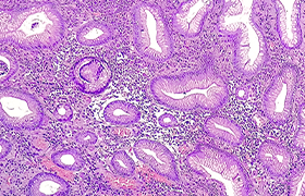 Abordaje inicial del tratamiento antibiótico de la infección por Helicobacter pylori