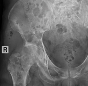 Inhibición de la actividad de osteoclastos en pacientes con metástasis a hueso de tumor sólido