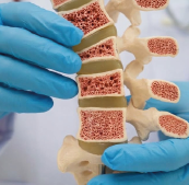 Monitoreo de la terapia inicial con bifosfonatos orales en mujeres posmenopáusicas con osteoporosis