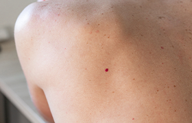 Tratamiento de los hemangiomas infantiles