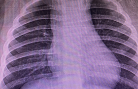 Tratamiento del síndrome de vena cava por neoplasia