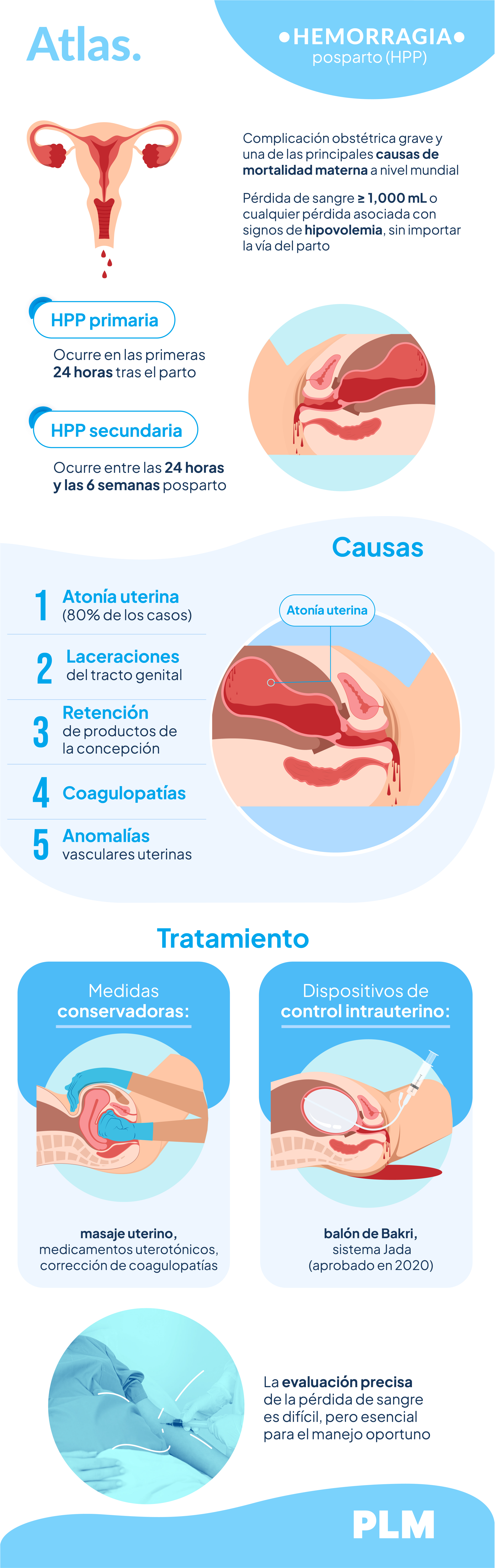 Hemorragia posparto (HPP)