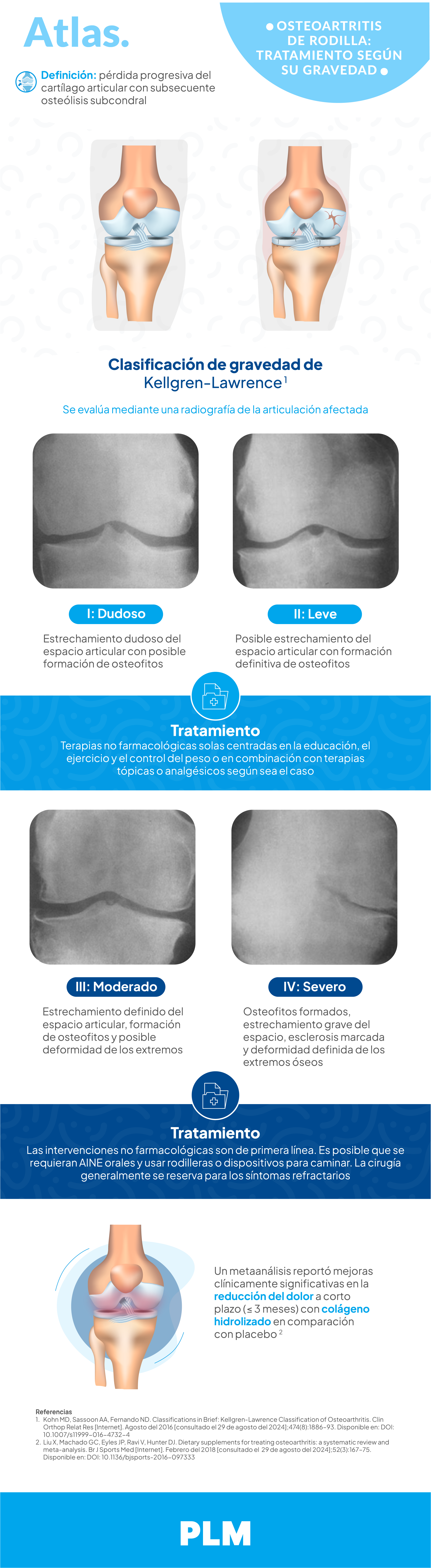 Osteoartritis de rodilla: tratamiento segun su gravedad