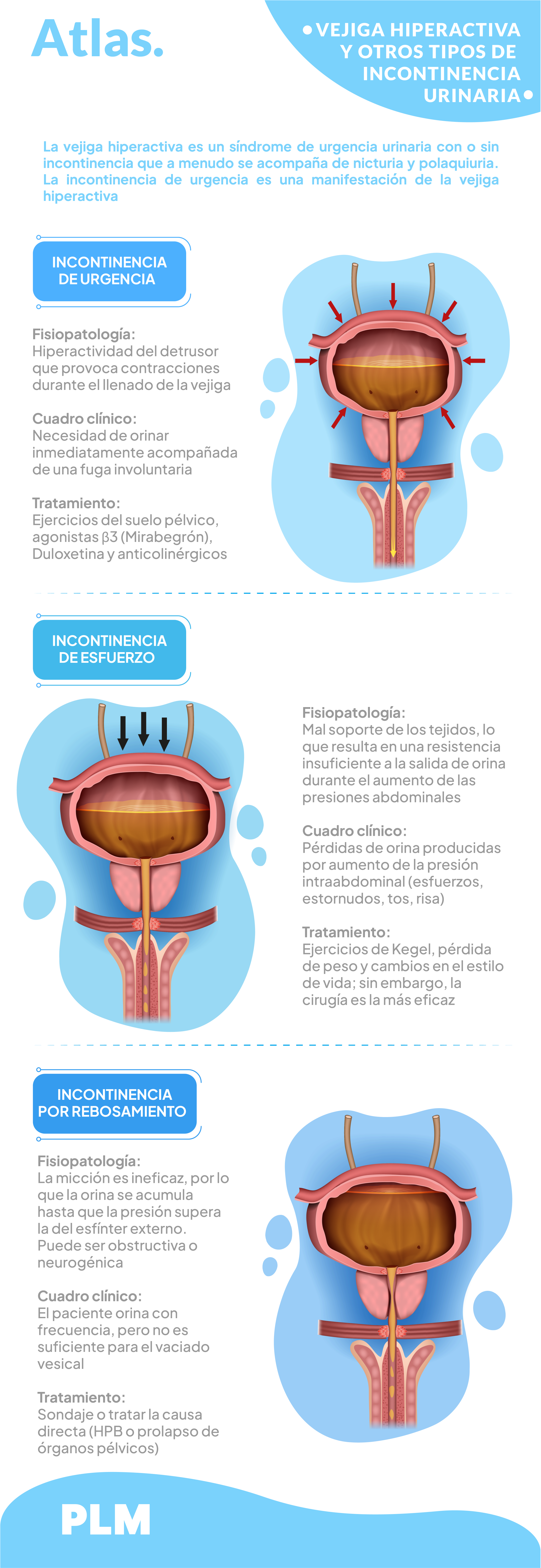 Vejiga hiperactiva y otros tipos de incontinencia urinaria