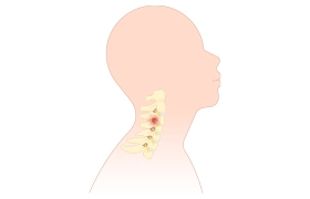 Escala de clasificación y severidad de lesiones subaxiales (SLICS)